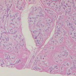 fibroadenoma_breast_rgb